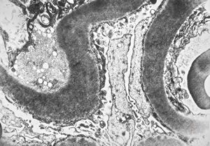 M,22y. | type II membranoproliferative glomerulonephritis